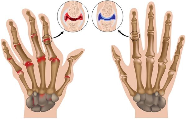 Verformung der Finger aufgrund von Arthrose