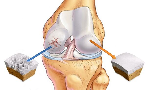 gesunder und von Arthrose betroffener Knorpel
