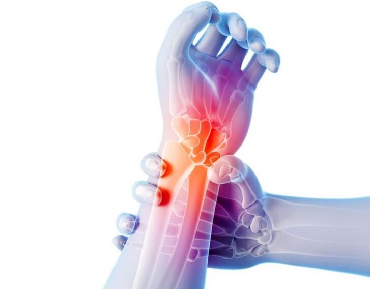 Eine Arthrose der Gelenke geht mit Schmerzen einher und erfordert eine komplexe Behandlung