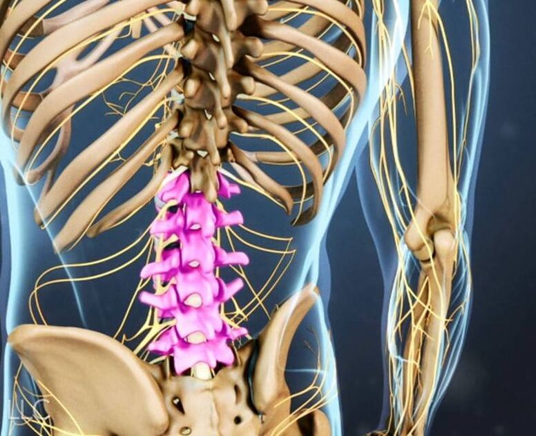 Osteochondrose der Lendenwirbelsäule