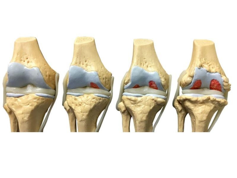 Grad der Arthrose der Gelenke