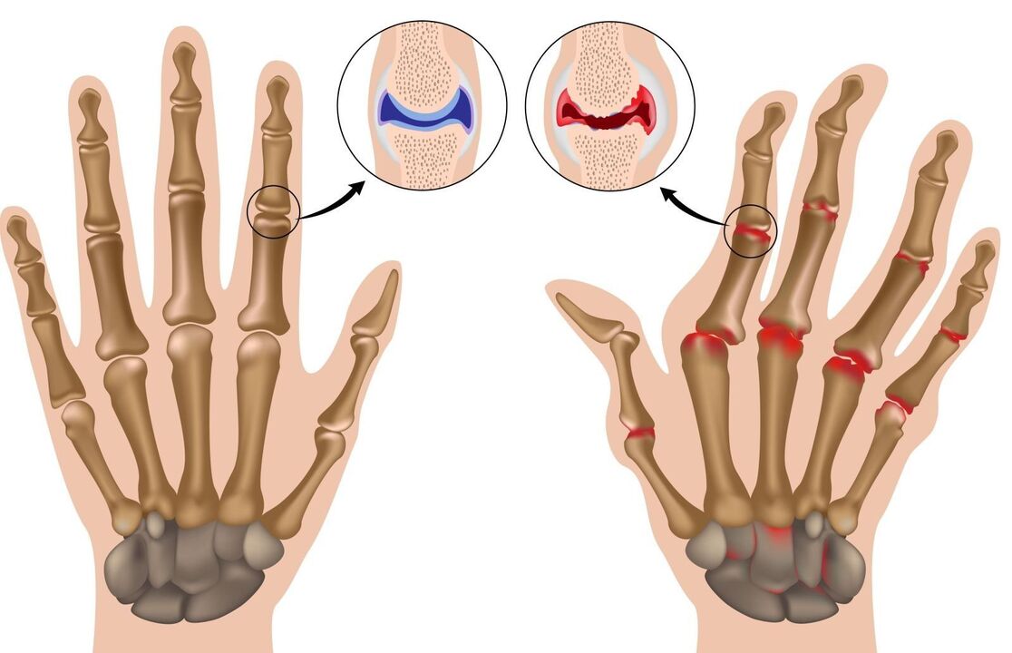 rheumatoide Arthritis